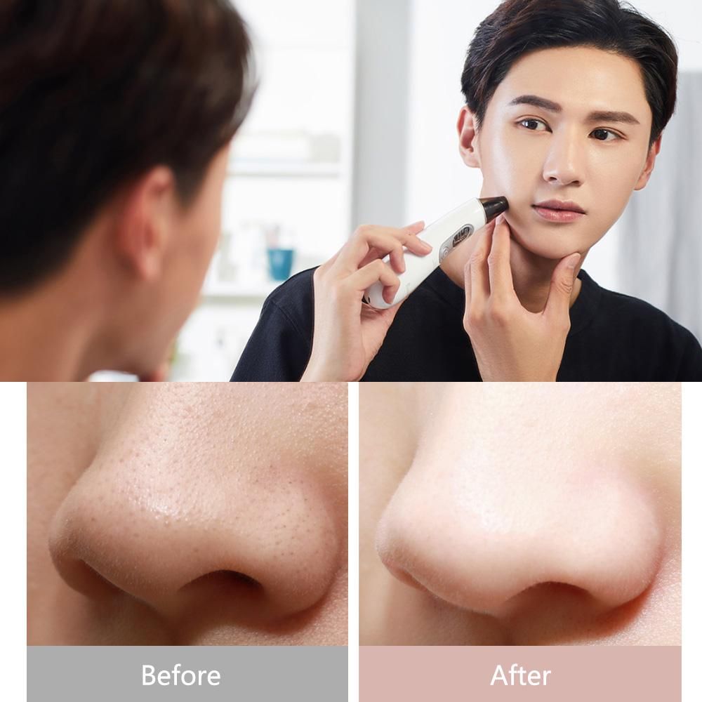 Xiaomi Wellskins Electric Blackhead Cleaner Deep Pore Cleanser Acne Pimple Remova (1)